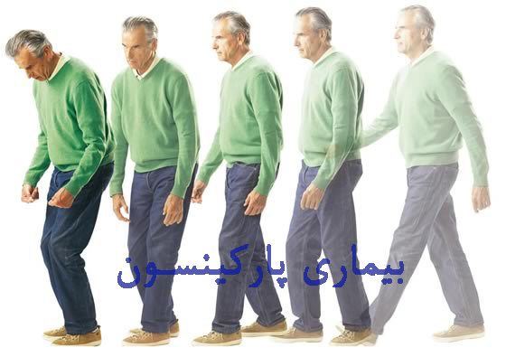 تعریف پارکینسون