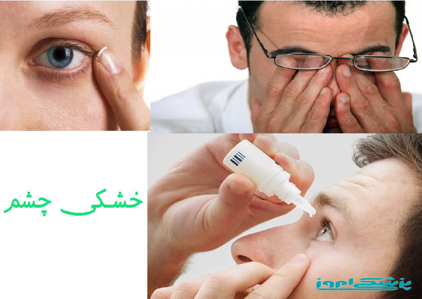 خارجشدن پلاک