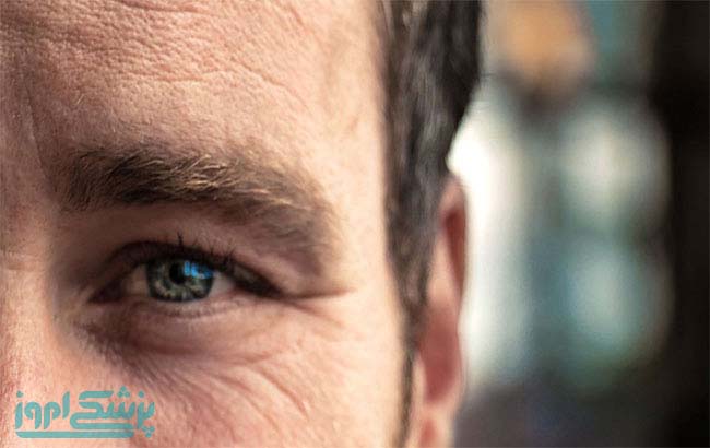 چین و چروک&zwnj;های کنار چشم&zwnj;ها (پای مرغابی)