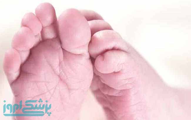 می&zwnj;توان کرن&zwnj;ایکتروس را درمان کرد
